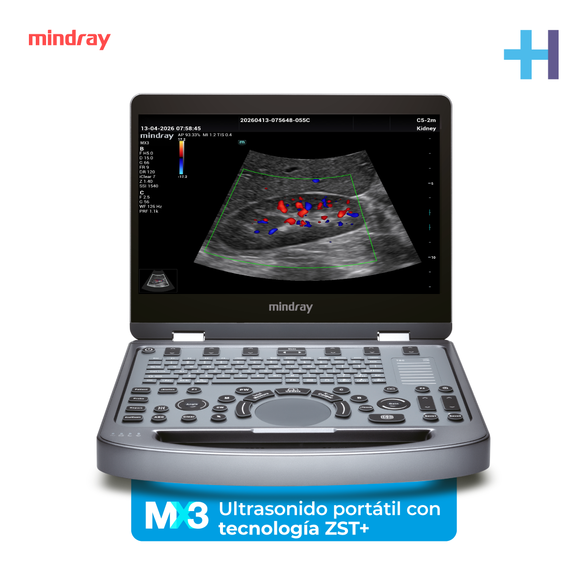 Ultrasonido Portátil MX3 Mindray con Tecnología ZST+ | Ecógrafo Profesional de Diagnóstico | Mindray
