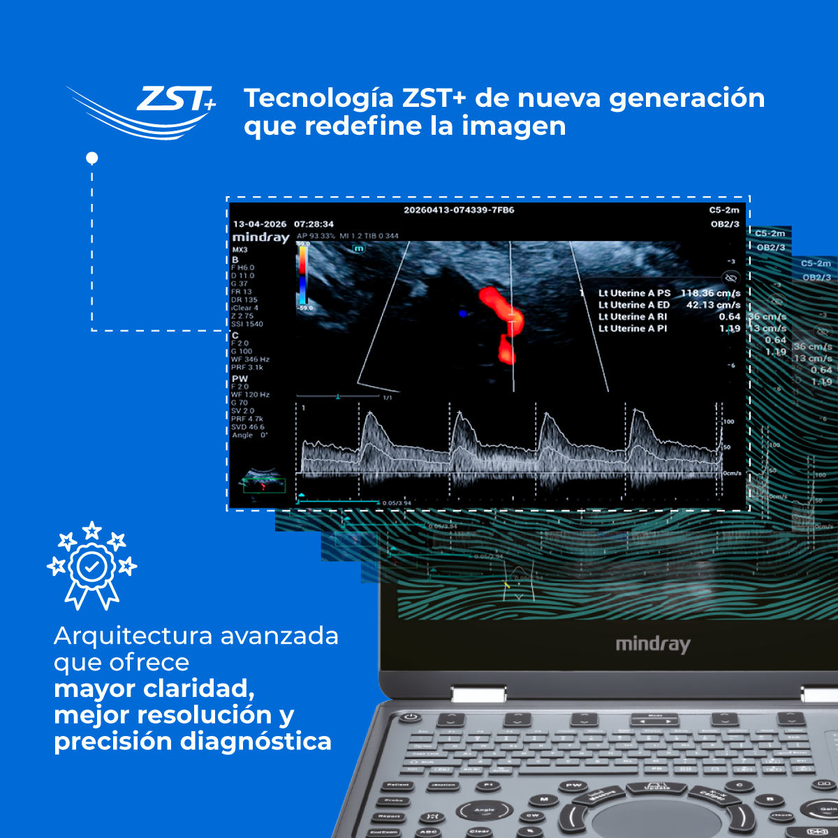Ultrasonido Portátil MX3 Mindray con Tecnología ZST+ | Ecógrafo Profesional de Diagnóstico | Mindray