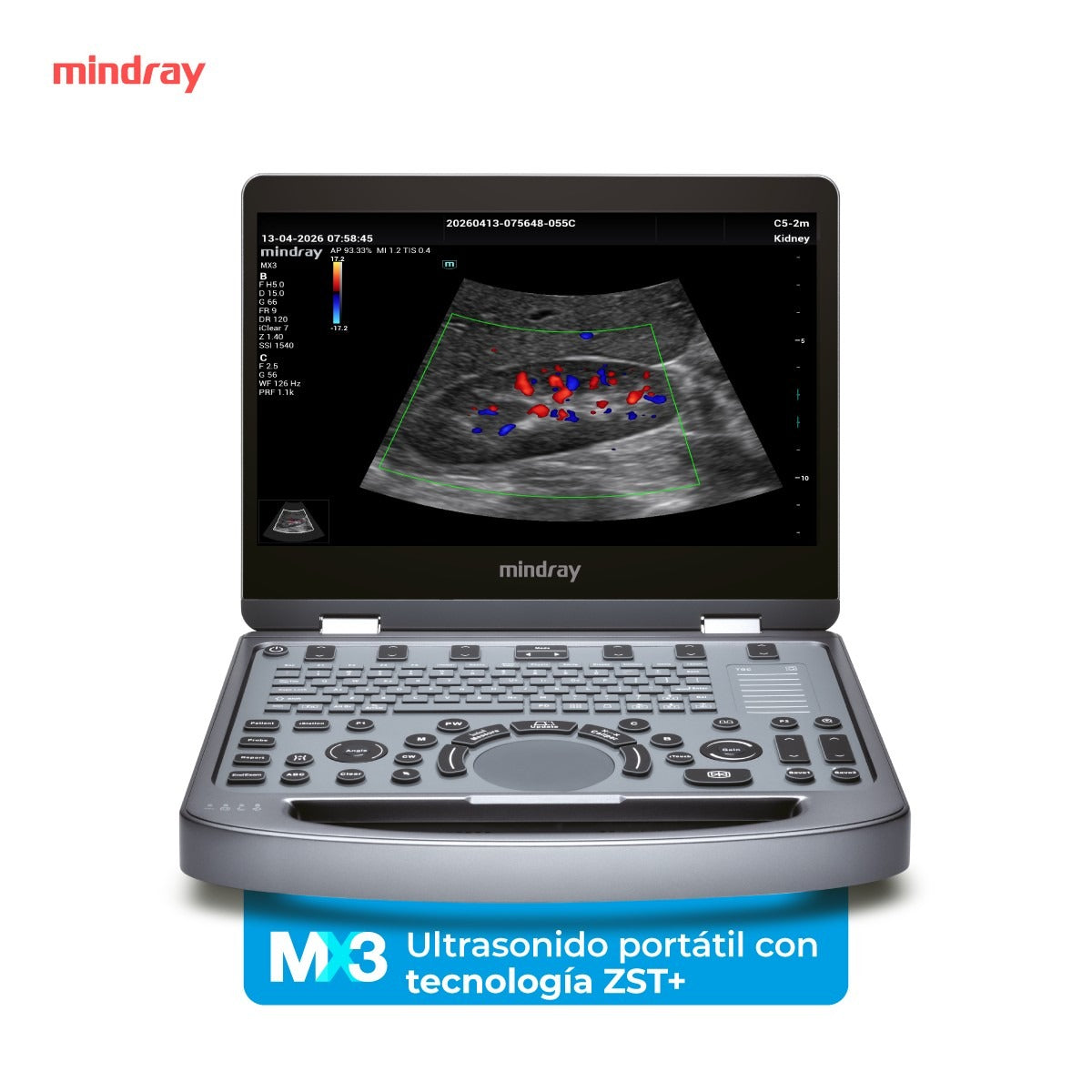 Ultrasonido Portátil MX3 Mindray con Tecnología ZST+ | Ecógrafo Profesional de Diagnóstico | Mindray