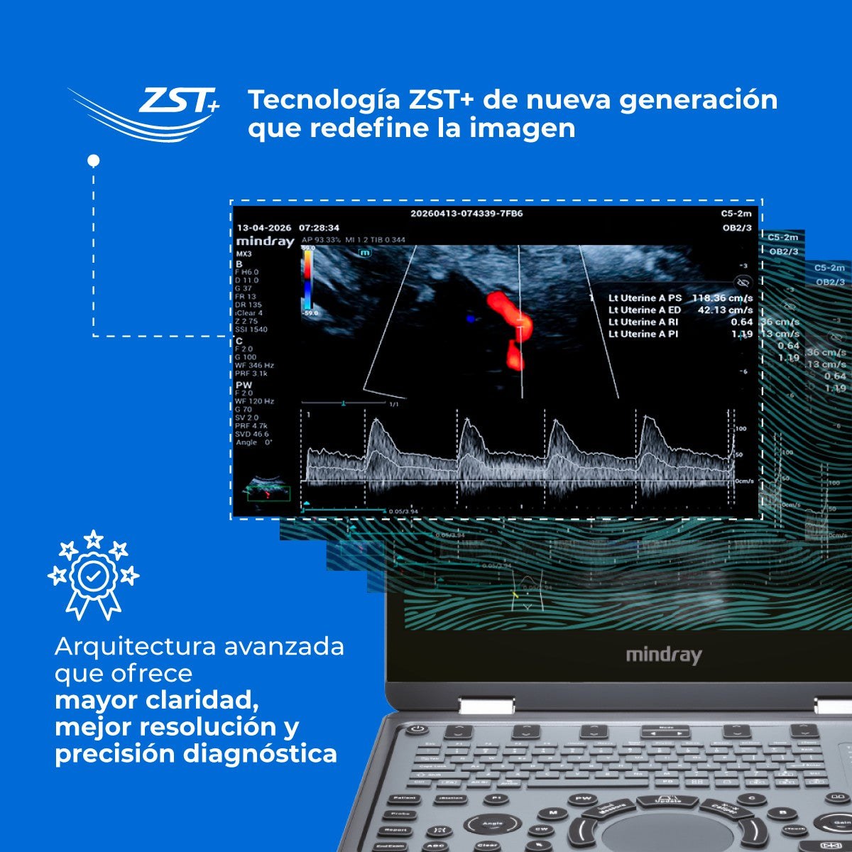Ultrasonido Portátil MX3 Mindray con Tecnología ZST+ | Ecógrafo Profesional de Diagnóstico | Mindray